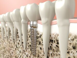 Model of dental implant in bone